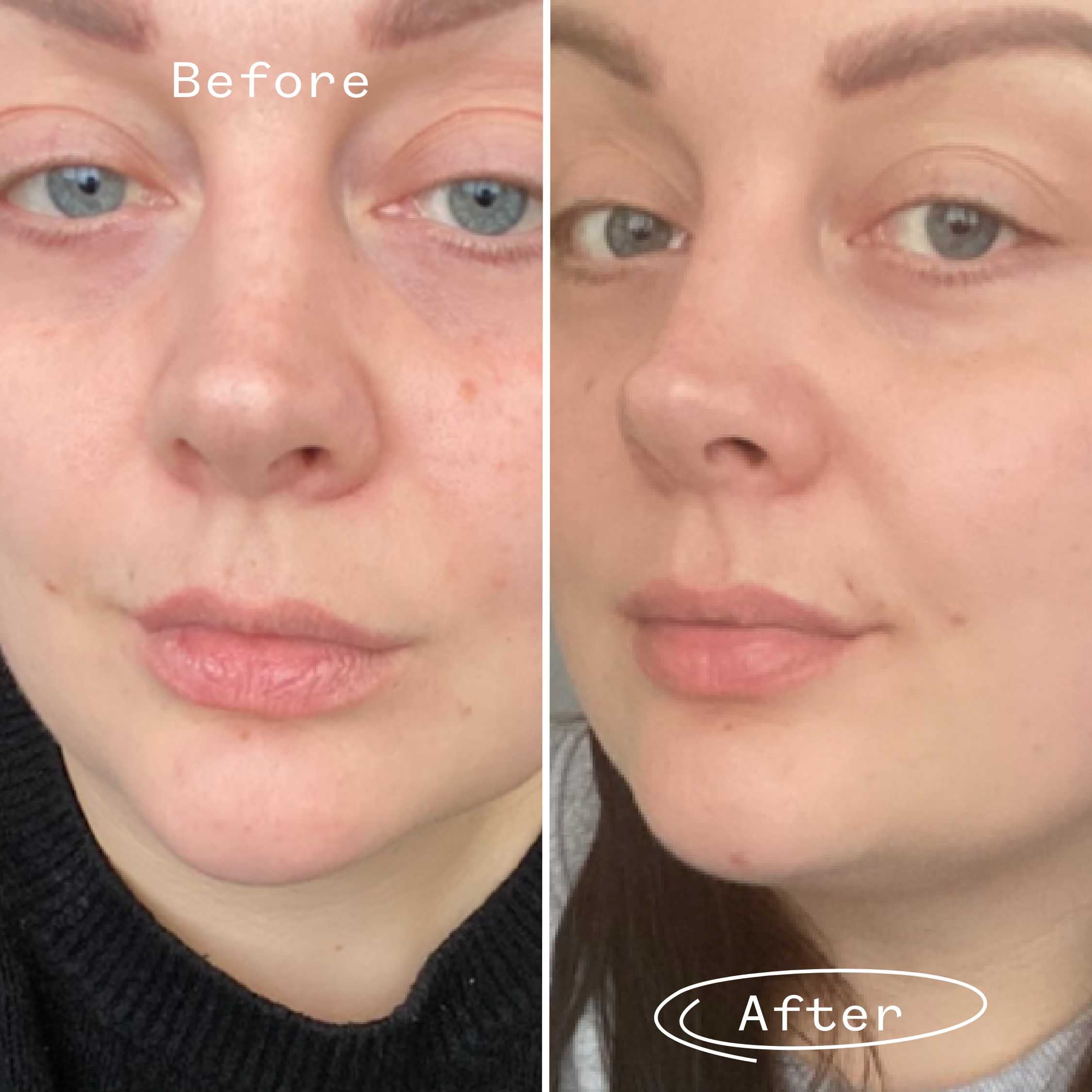 rose hip seed oil before and after Rosehip Oil for Face | Rosehip Seed Face Oil