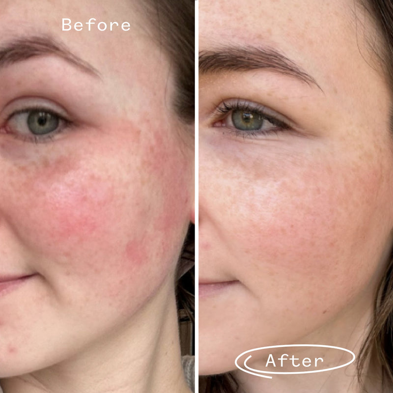 Niss's Skincare Journey Post Pill and Post Accutane - MYSA